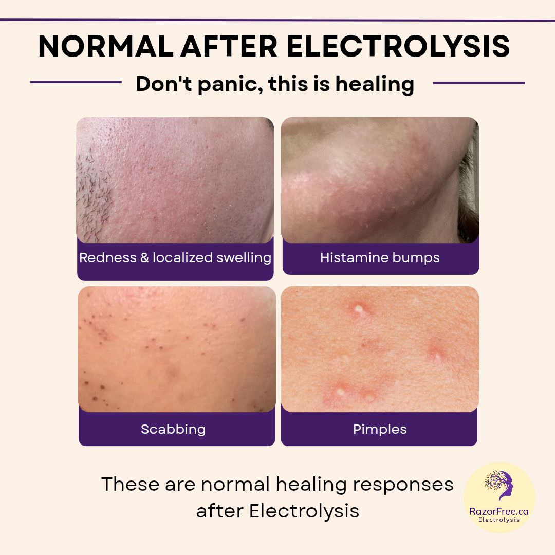 Infographic showing four images of normal healing reactions to electrolysis, including redness, swelling, histamine bumps, pinpoint scaps, and whiteheads. Source: RazorFree.Ca 