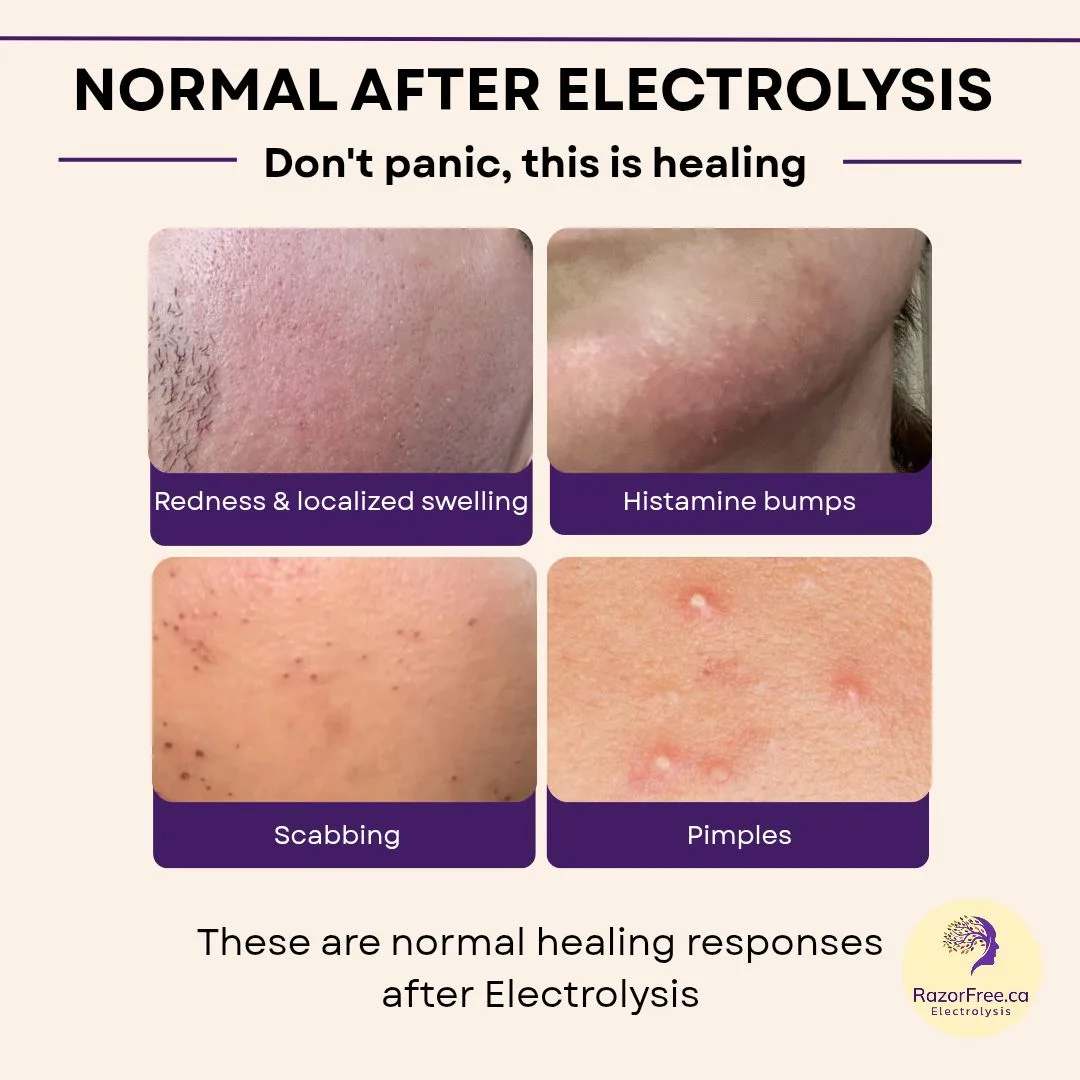 Infographic showing four images of normal healing reactions to electrolysis, including redness, swelling, histamine bumps, pinpoint scaps, and whiteheads. Source: RazorFree.Ca 